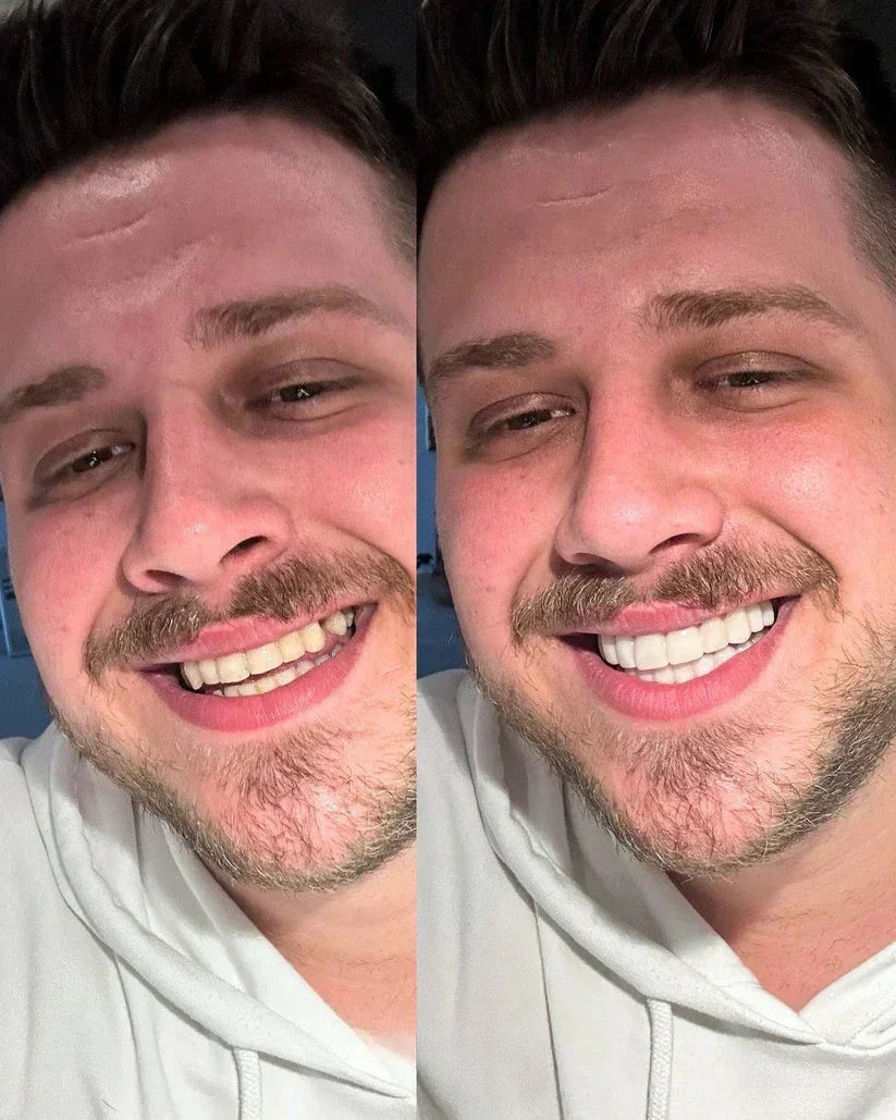 InstaSmile Pro Cosmetic Veneers