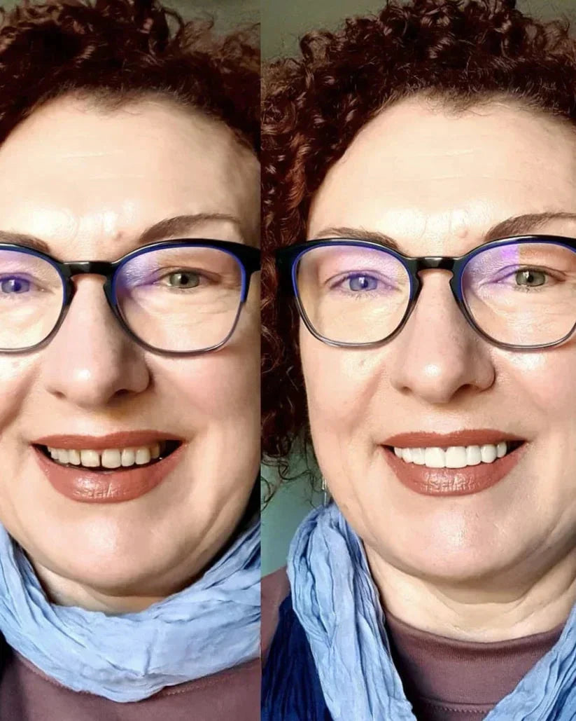 InstaSmile Pro Cosmetic Veneers