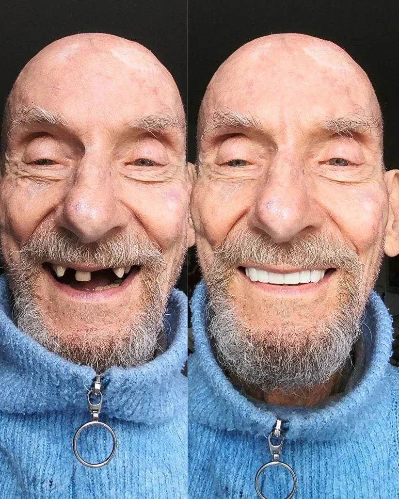 InstaSmile Pro Cosmetic Veneers